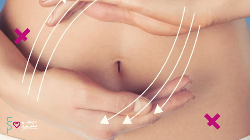 لیپوساکشن شکم | عمل جراحی زیبایی شکم و پهلو